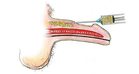 Инжекции на хиалуронова киселина в цевта на член, за да се увеличи